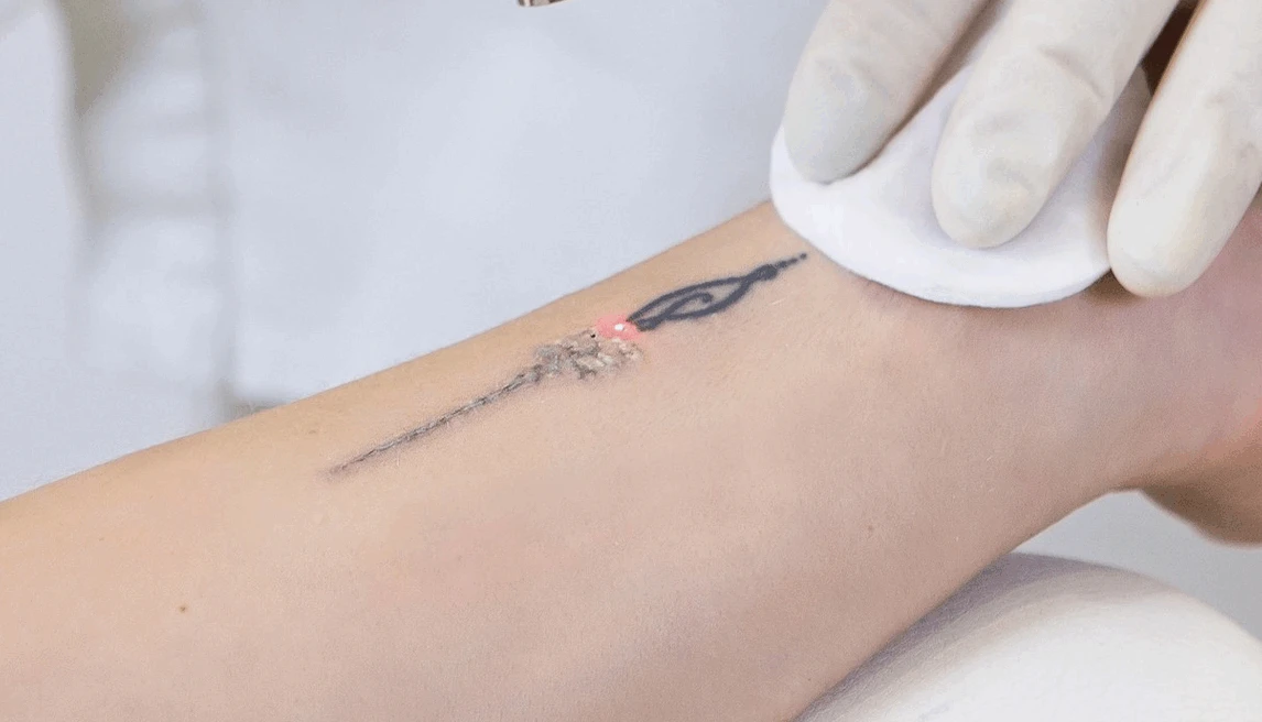 picolaser tattoo removal picolaser tattoo removal